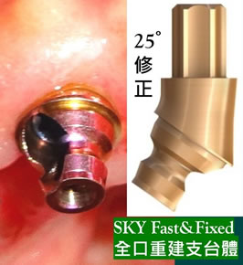圖2 全口植牙重建-植入德國晴空 SKY 植體後立即裝上  SKY Fast&Fixed 全口重建支台體